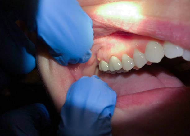 Best Chipped Tooth Repair Near Me  in Big Coppitt Key, FL